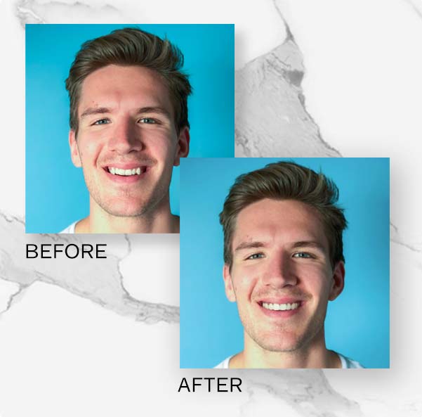 before after invisalign man